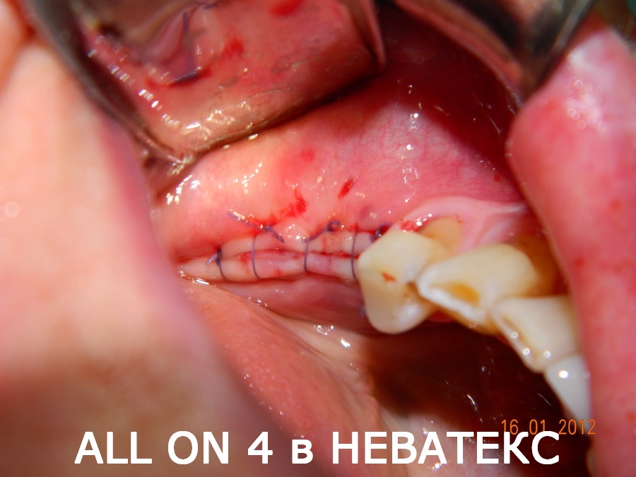 Бескровная операция All on 4 all on 4